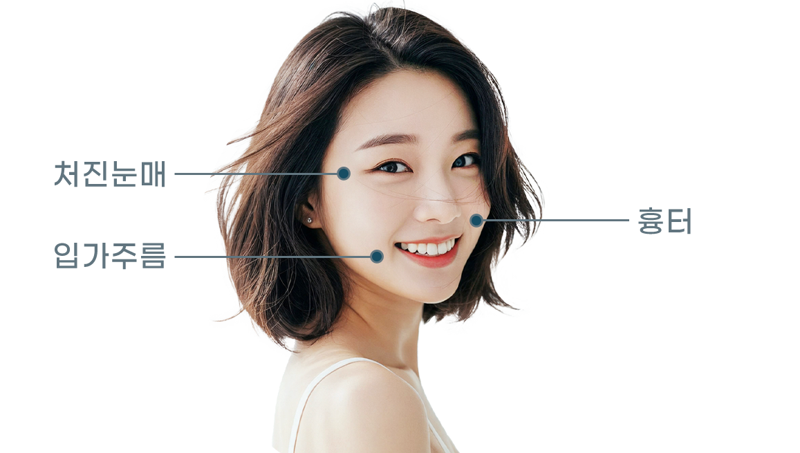프렉사 레이저